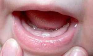 8 причин возникновения стоматит у ребенка: фото во рту и на щеках, лечение в домашних условиях