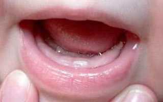 8 причин возникновения стоматит у ребенка: фото во рту и на щеках, лечение в домашних условиях