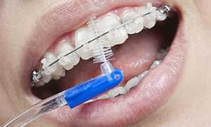 Нелегкий щепетильный уход: как чистить брекеты, чтобы не повредить зубную эмаль?