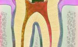 Периодонтит: профилактика