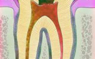 Периодонтит: профилактика