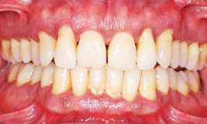 Запущенная болезнь может привести к потере зубов! Пародонтоз: чем его лечить?