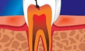 Особенности пульпита хронической формы