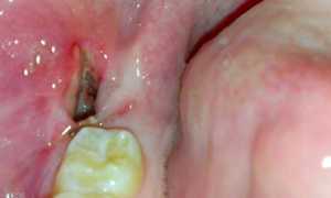 Как подготовиться и провести операцию с минимальными последствиями: удаление зуба мудрости