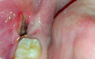 Как подготовиться и провести операцию с минимальными последствиями: удаление зуба мудрости