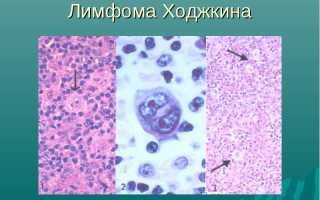 Рак лимфоузлов: симптомы и лечение