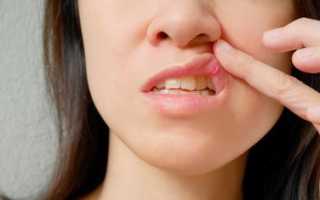 Что такое стоматит и как с ним бороться? Все виды заболевания и методы их лечения