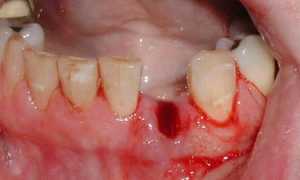 Когда неприятные ощущения не являются нормой: осложнения после удаления зуба