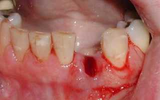 Когда неприятные ощущения не являются нормой: осложнения после удаления зуба