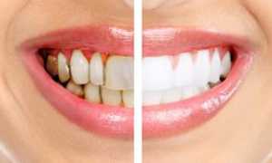 Как с этим бороться? Зубной камень: снятие и удаление, особенности чистки, фото до и после