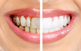 Как с этим бороться? Зубной камень: снятие и удаление, особенности чистки, фото до и после