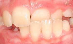 Аномалии и норма: виды прикуса. Методы исправления дефектов