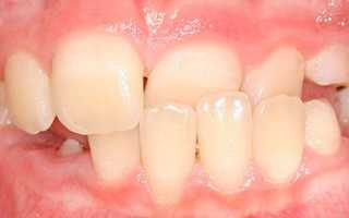 Аномалии и норма: виды прикуса. Методы исправления дефектов