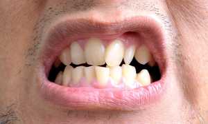 Лечение неправильного прикуса без использования брекетных систем