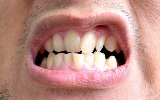 Лечение неправильного прикуса без использования брекетных систем