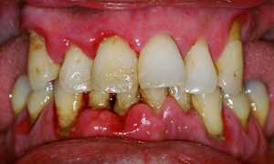 Полезные процедуры, которые помогут избавиться от пародонтита: лечение современными методами