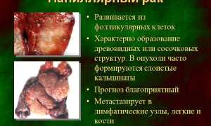 Папиллярный рак: причины, симптомы и лечение
