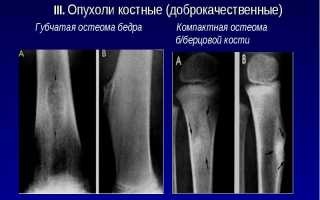 Остеома бедренной кости: симптомы и лечение