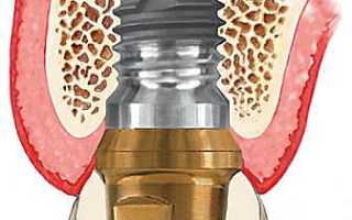 Протезирование верхних зубов: виды протезов, описание