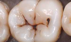 5 причин, по которым возникает кариес. Симптомы патологии и методы лечения