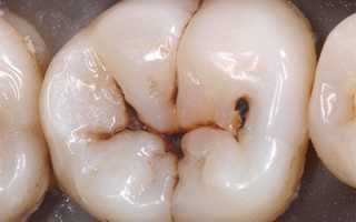 5 причин, по которым возникает кариес. Симптомы патологии и методы лечения