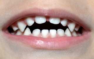 Открытый прикус: причины, симптомы, лечение, профилактика