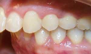 Дистальный прикус: как обнаружить и что делать