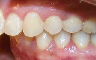 Дистальный прикус: как обнаружить и что делать