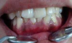 Язвенный гингивит: этиология, особенности течения, методы лечения