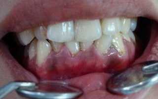 Язвенный гингивит: этиология, особенности течения, методы лечения