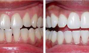 Отбеливание зубов по системе Zoom