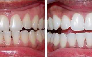 Отбеливание зубов по системе Zoom