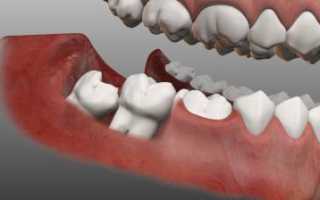 Как проходит удаление зубов мудрости: последствия и осложнения