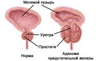 Доброкачественная гиперплазия аденомы простаты: симптомы и лечение
