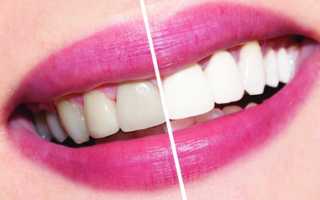 Сделать эмаль светлее на несколько тонов легко и просто! Системы для отбеливания зубов в домашних условиях