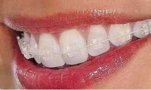 Эстетическая ортодонтия – прозрачные брекеты