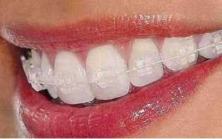 Эстетическая ортодонтия – прозрачные брекеты