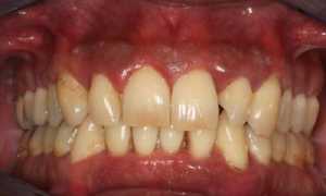 Нет только неприятные ощущения, но и угроза потери зубов! Пародонтит: что это такое