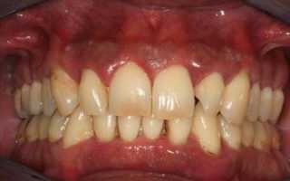 Нет только неприятные ощущения, но и угроза потери зубов! Пародонтит: что это такое