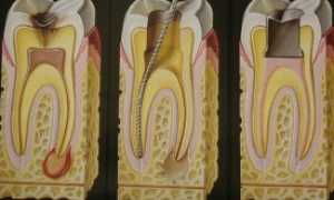 Причины возникновения зубной боли после обработки корневых каналов