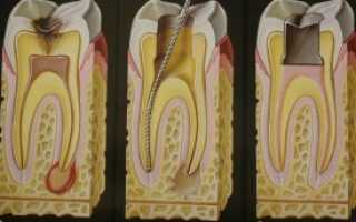 Причины возникновения зубной боли после обработки корневых каналов