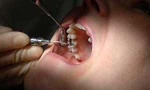 Ноющие или фантомные боли после удаления зуба – это норма! Но что делать, если очень сильно мешает?