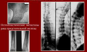Остеобластические и остеолитические метастазы