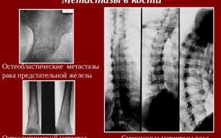 Остеобластические и остеолитические метастазы