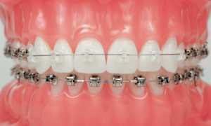 Лечение неправильного прикуса брекет-системами