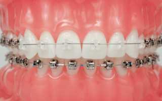 Лечение неправильного прикуса брекет-системами