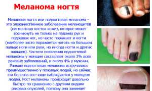 Симптомы и лечение подногтевой меланомы