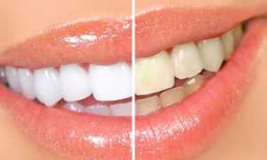 Какие самые эффективные средства для отбеливания зубов можно найти в аптеках?