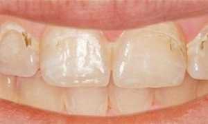 Поверхностный кариес: этиология, симптомы и методы лечения