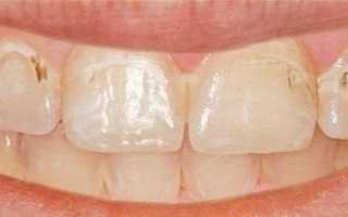 Поверхностный кариес: этиология, симптомы и методы лечения